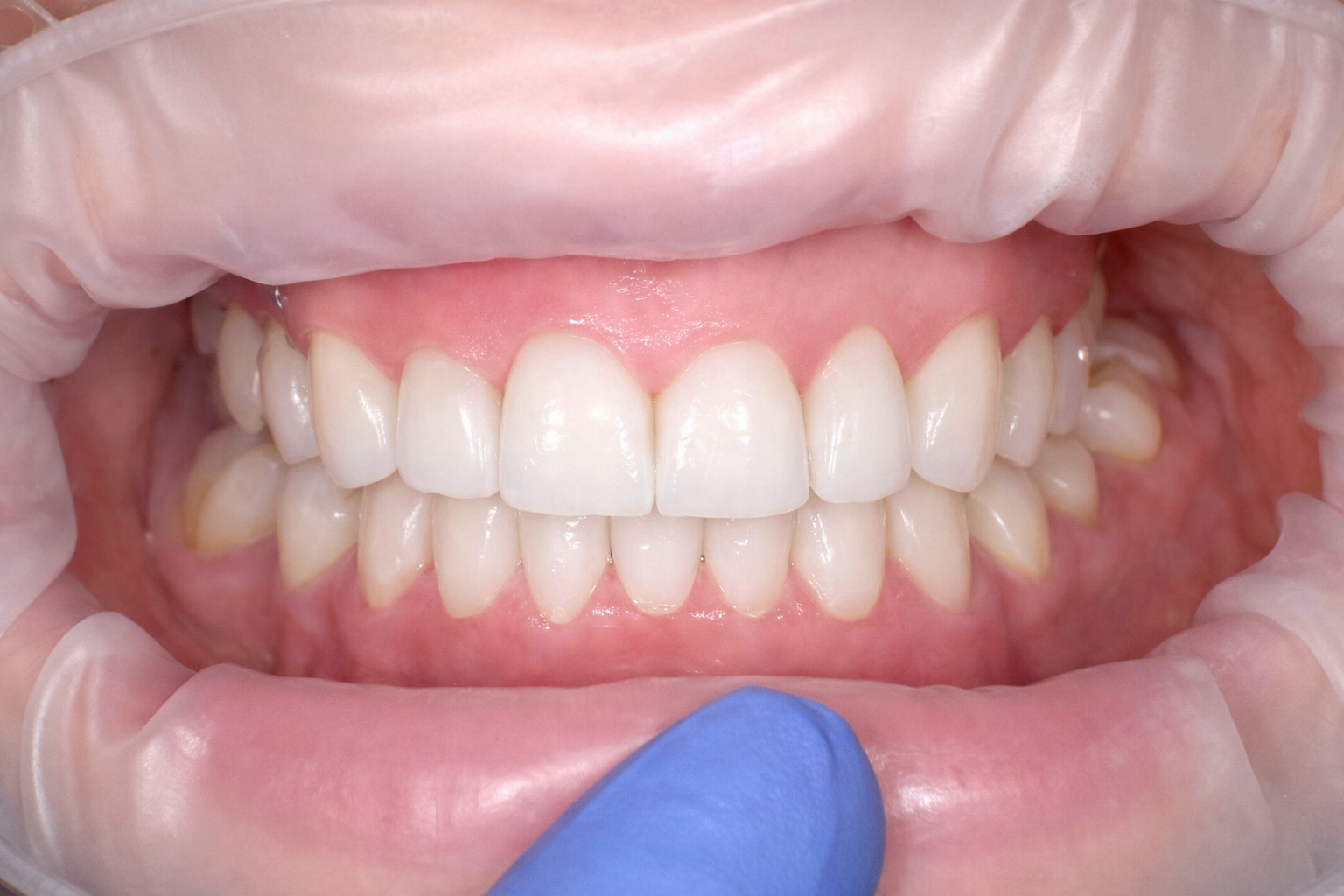Pict0142 – Edit - Perfect Smile Dental Centre