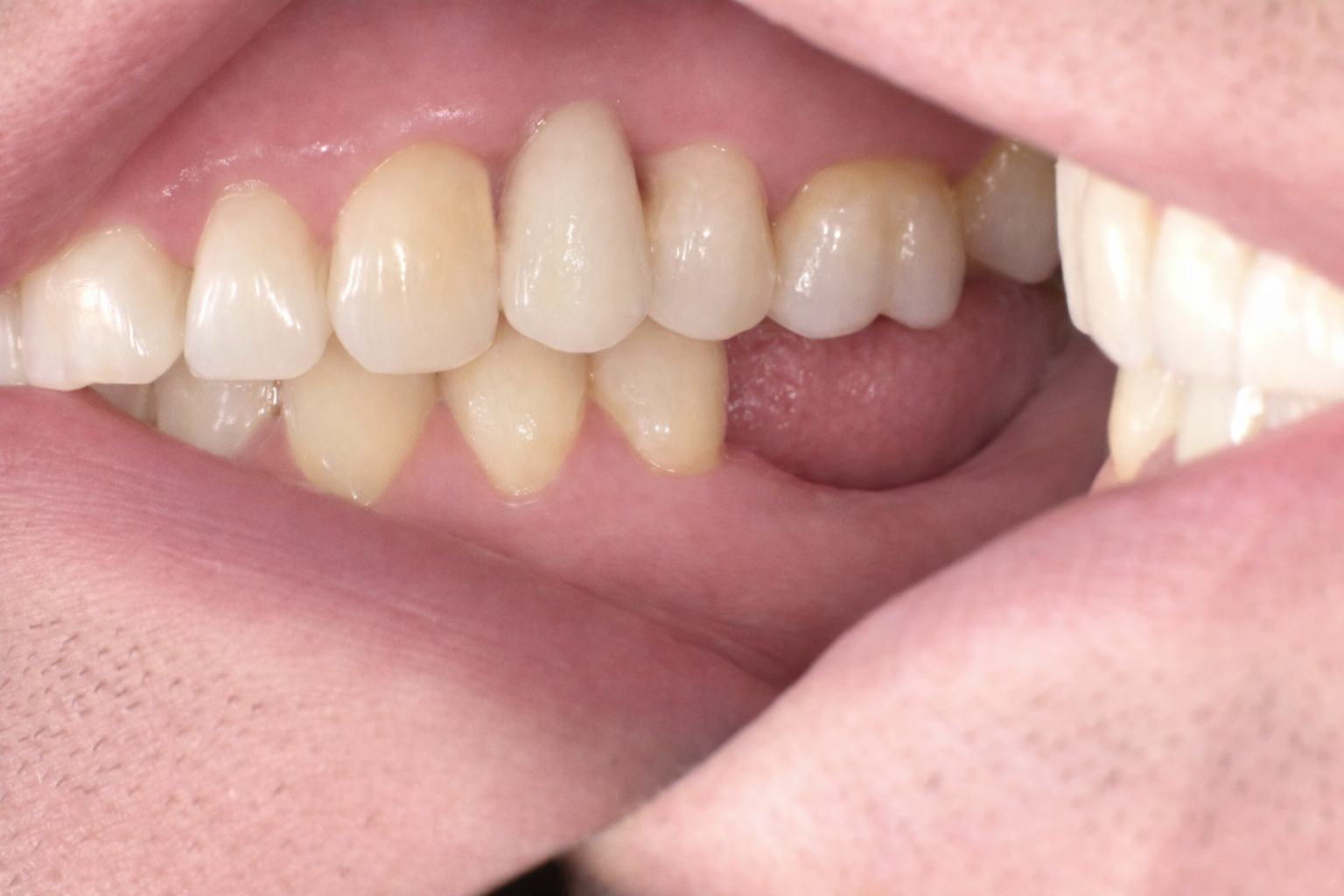 Pict2285 – Edit - Perfect Smile Dental Centre