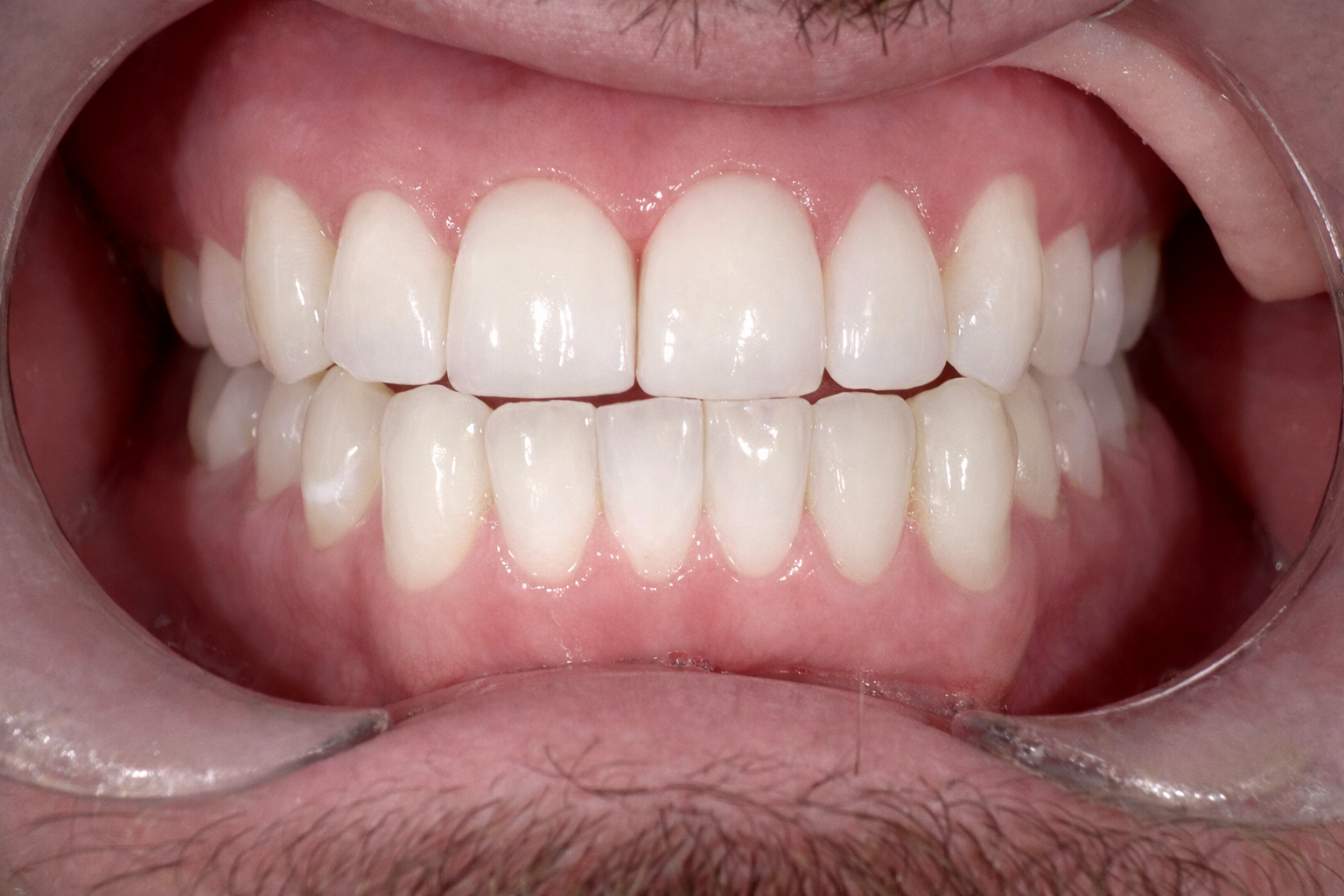 Pict3232 – Edit - Perfect Smile Dental Centre