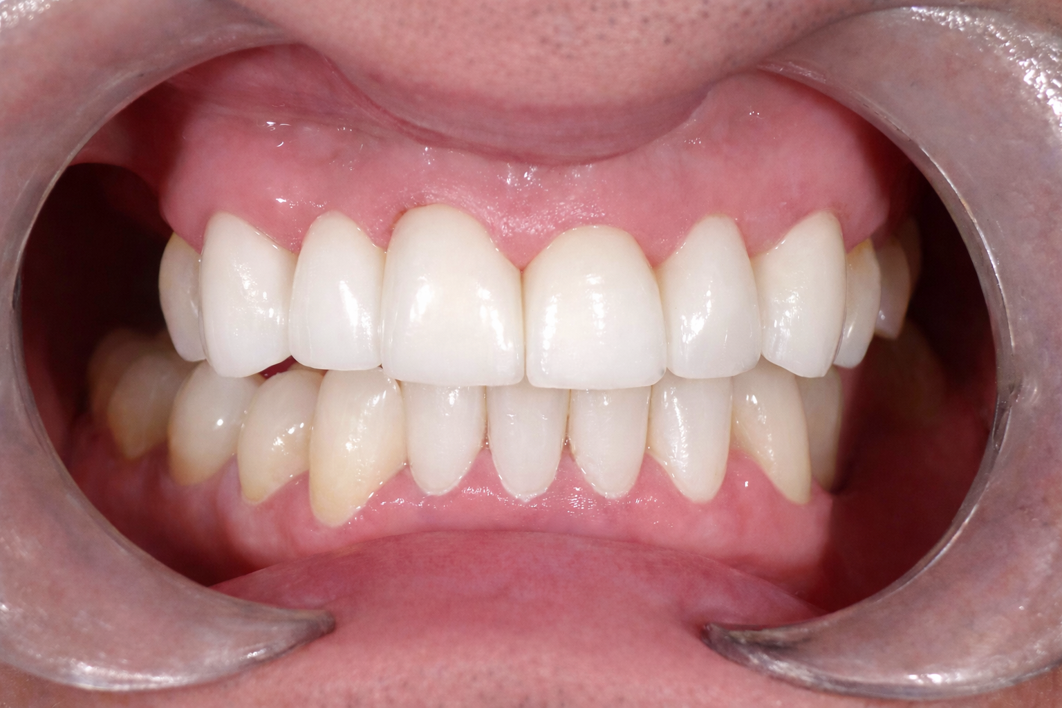 Pict3273 – Edit - Perfect Smile Dental Centre