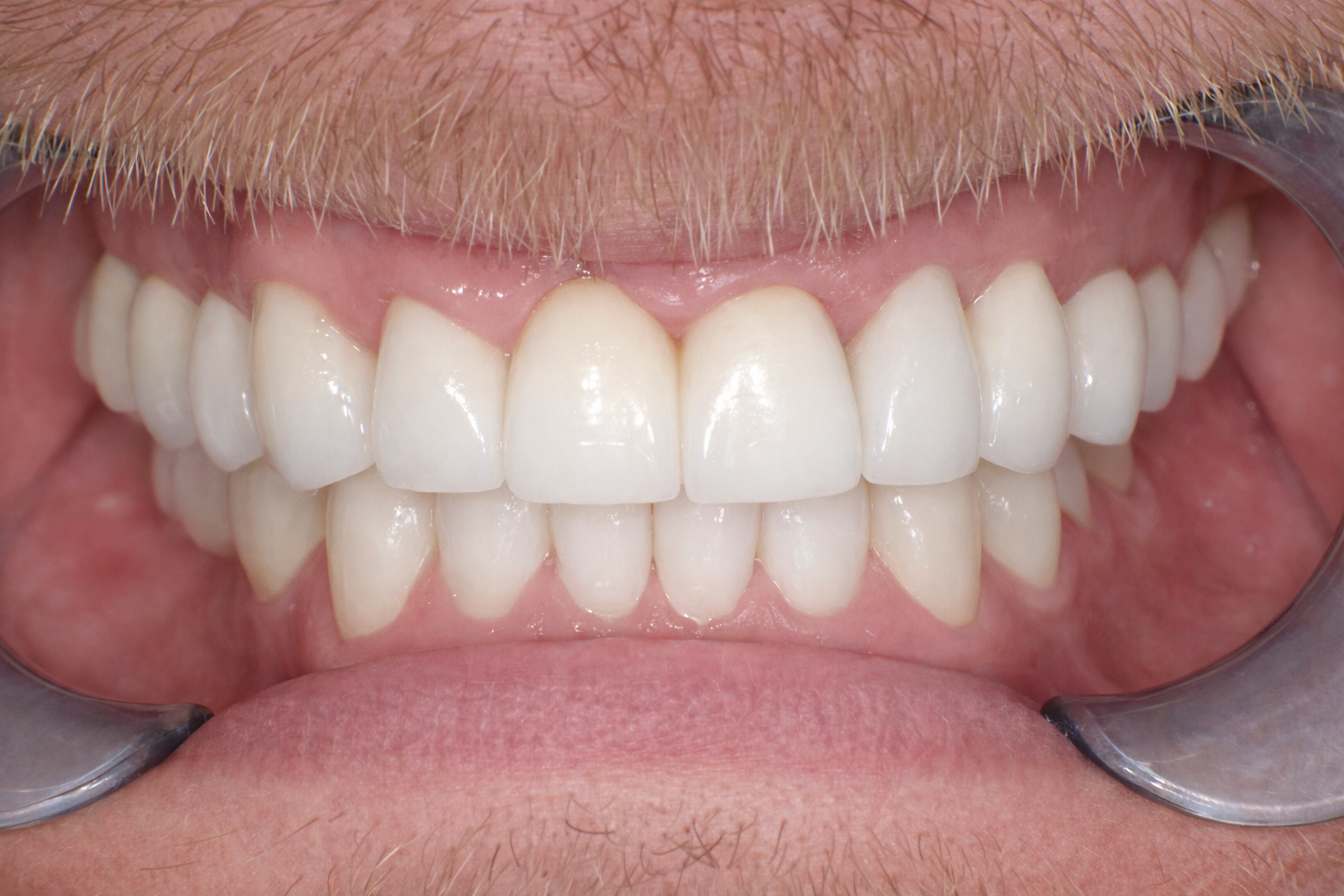 Pict8916 – Edit - Perfect Smile Dental Centre