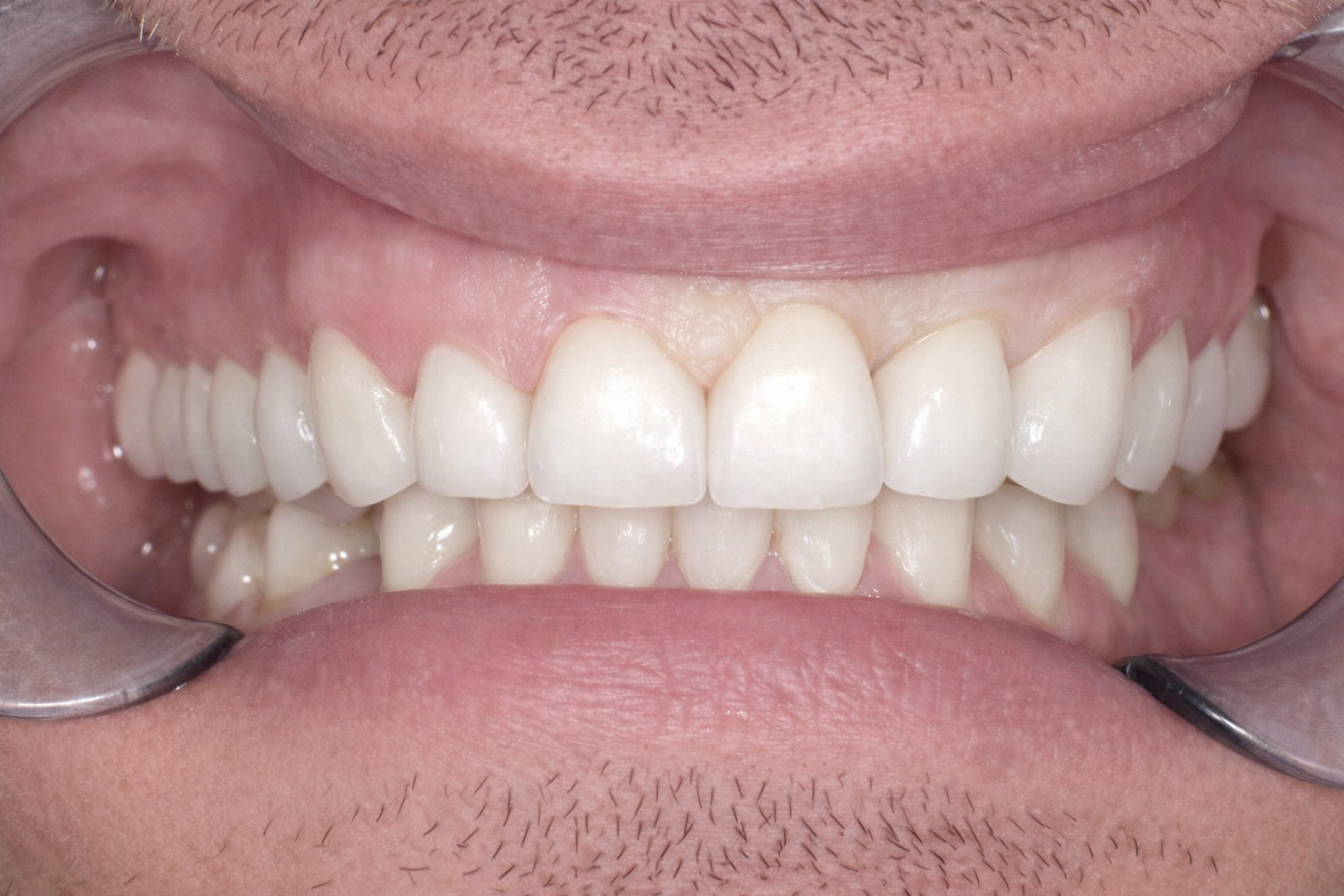 Pict9010 – Edit - Perfect Smile Dental Centre