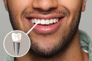 czy-implanty-dentystyczne-sa-bezpieczne-i-skuteczne